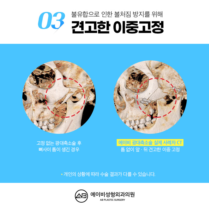 Can We Compare Before and After Cheekbone Surgery? image 5