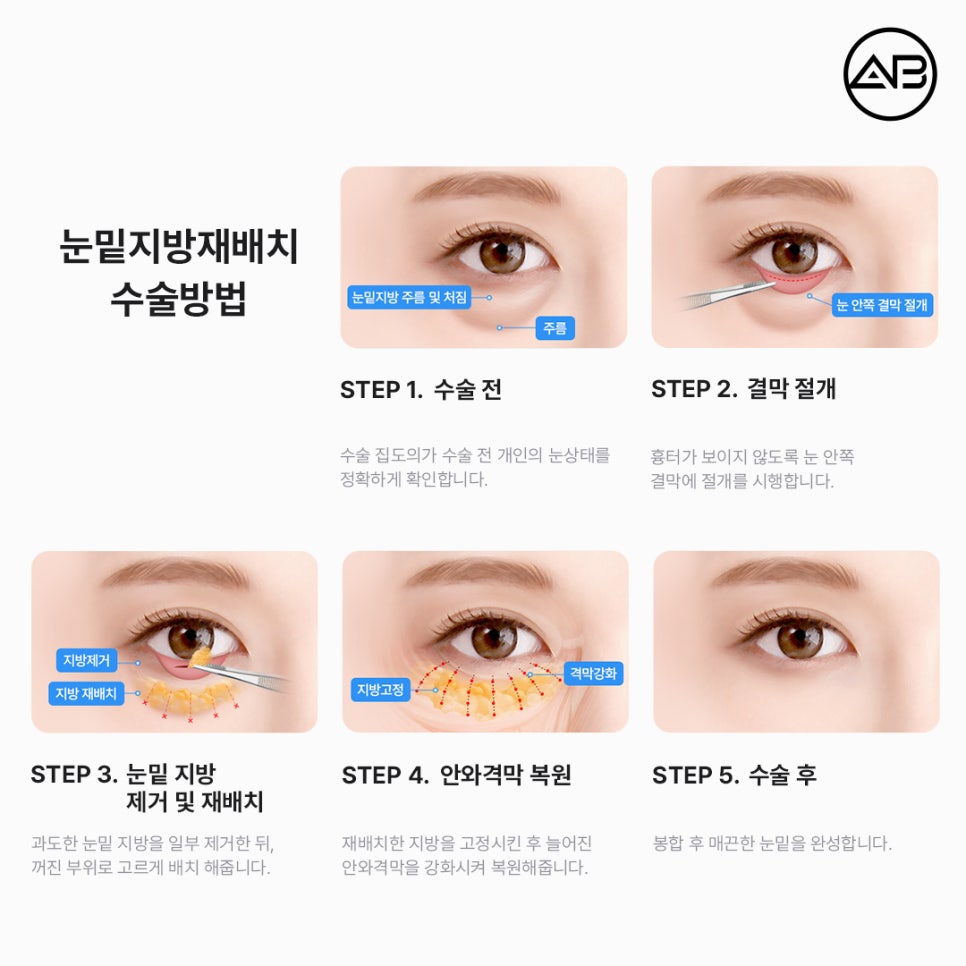 AB Plastic Surgery Under-Eye Fat Repositioning: Effects on Dark Circles and Hollow Under-Eyes, Before-and-After Results, and Side Effects image 2