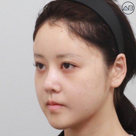 에이비성형외과 양악+윤곽수술(사각턱 턱끝) 케이스 리뷰 관련 이미지 6