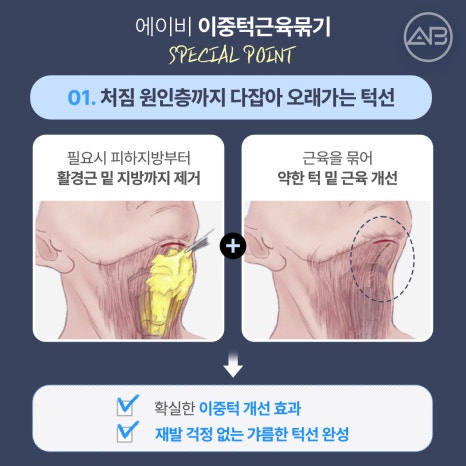 The Secret to a Slim Jawline, AB Plastic Surgery Double Chin Muscle Binding image 10