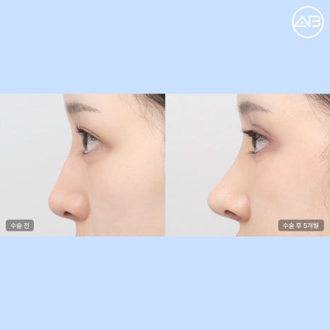 에이비성형외과 매부리코재수술 코절골술이 필요한 경우와 교정 원리 관련 이미지 3