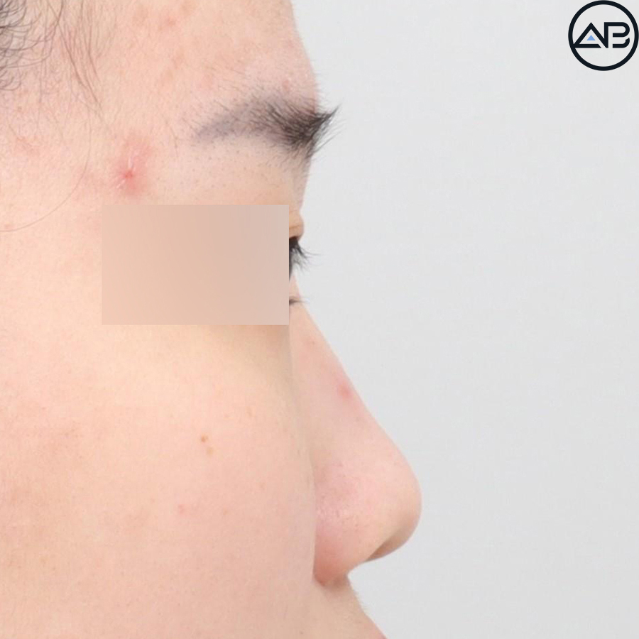 에이비성형외과 자려한코성형 케이스리뷰 관련 이미지 7