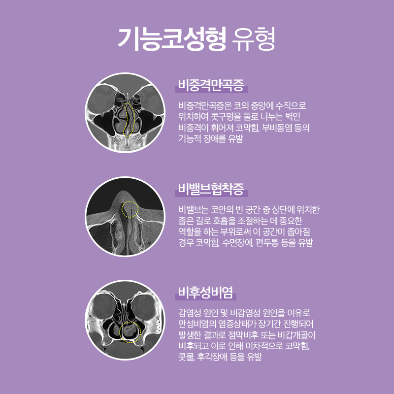 기능과 미용을 동시에! AB성형외과의 기능코성형 관련 이미지 2