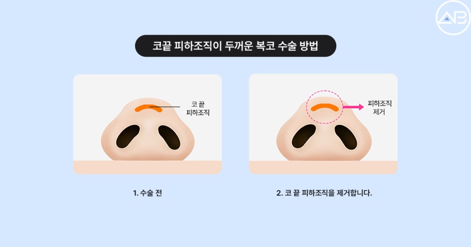 복코성형 전후효과 보려면? (Faet. 에이비성형외과 서찬얼원장) 관련 이미지 6