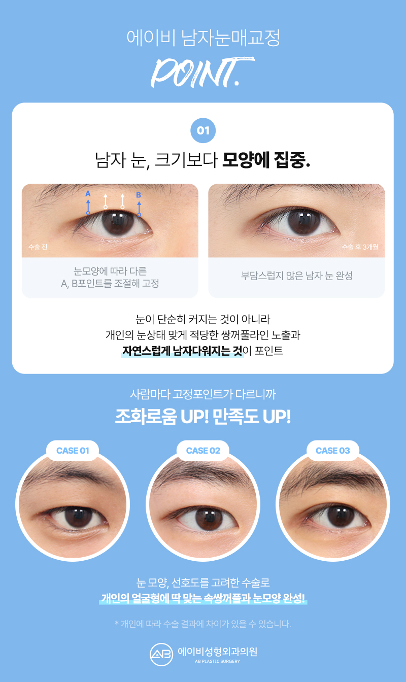 남자눈매교정 잘하는 에이비성형외과 다른점은 뭘까? 관련 이미지 6