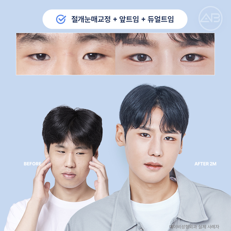인상을 바꾸는 첫 시작, 에이비성형외과 남자눈성형 관련 이미지 22