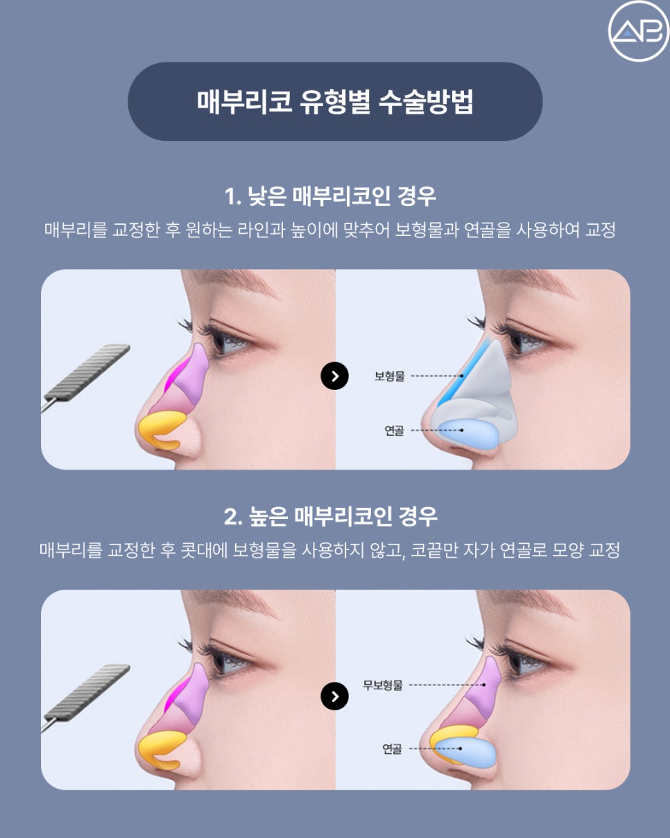 매부리코성형 자연스럽게 교정 원한다면 AB성형외과 관련 이미지 3