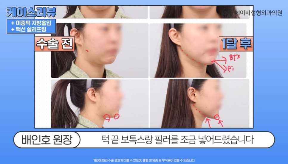 #AB Plastic Surgery #AB TV #Case Review #Double Chin Liposuction image 5