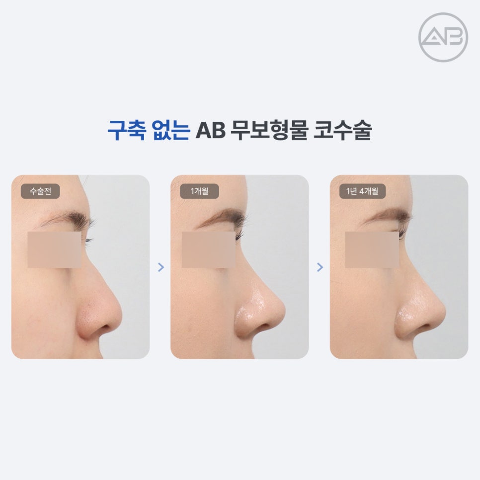 AB Plastic Surgery: Understanding Rhinoplasty Side Effects, Including Contracture, in Implant-Free Rhinoplasty image 4