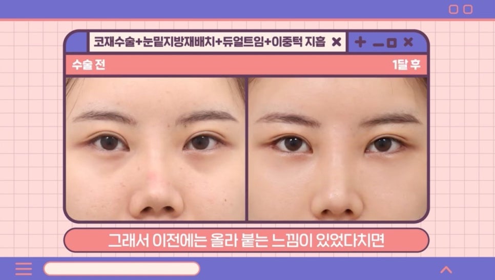 #AB Plastic Surgery #AB TV ##Case Review #Eye Surgery #Nose Revision Surgery image 6