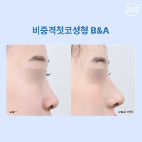 에이비성형외과 비중격첫코성형 꼭 늑연골이 필요할까? 비중격 귀연골 코성형 Q&A 관련 이미지 4
