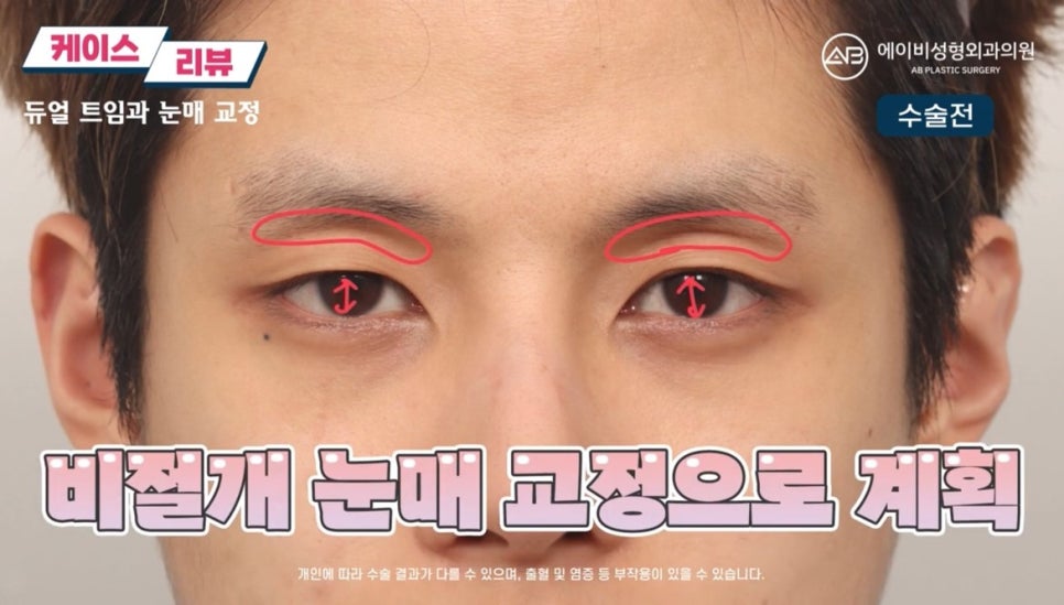 #에이비성형외과#에이비tv#눈성형#남자눈성형 관련 이미지 2