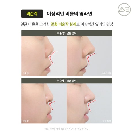 에이비성형외과 자가늑연골 비주라인 코재수술 시기와 교정 체크포인트 관련 이미지 13