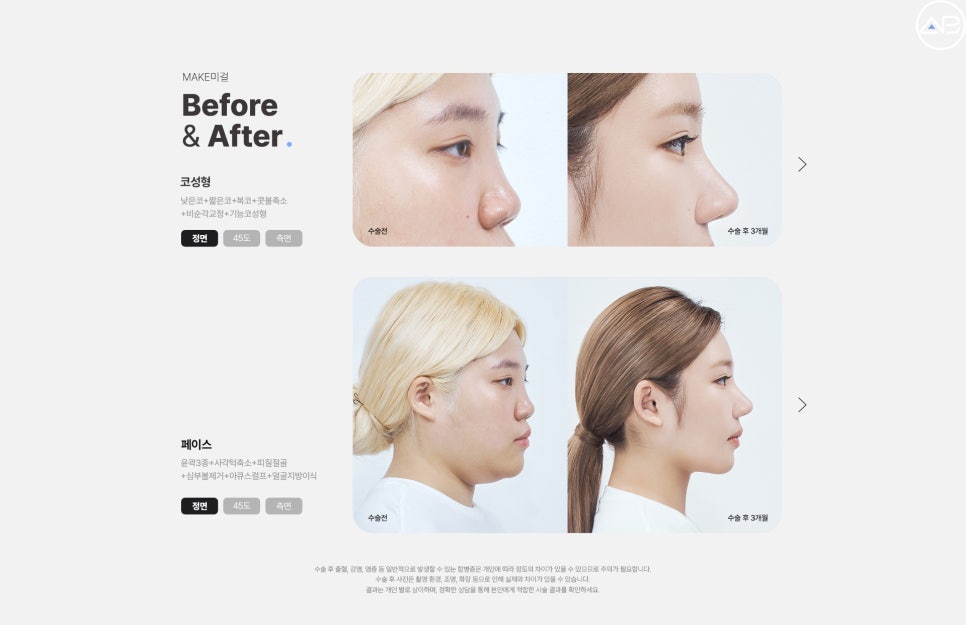 맥미걸 (MAKEMEGirl) 빛바랜금손, 자연스럽게 개선한 복코성형 리얼 후기 관련 이미지 6