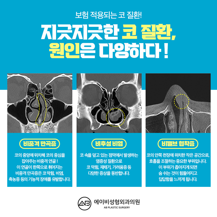 비염코성형실비 어떻게 할까? 관련 이미지 3