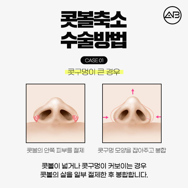 콧볼축소수술 코뚠뚠이의 해결책 관련 이미지 4