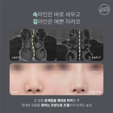자려한코성형 원한다면 에이비성형외과 관련 이미지 3