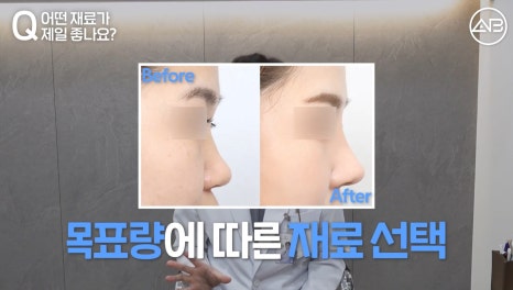 #AB Plastic Surgery #AB TV #Nose Surgery #First Nose Surgery image 10
