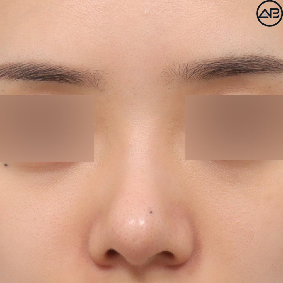 AB Plastic Surgery Refined Rhinoplasty - Revision Surgery Case Review image 1