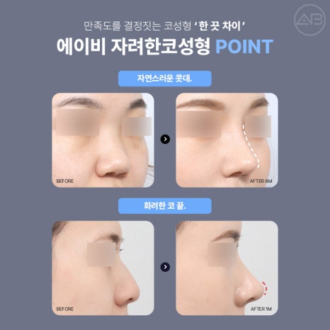 에이비성형외과에서 만나는 자려한 비주라인 코성형 관련 이미지 3