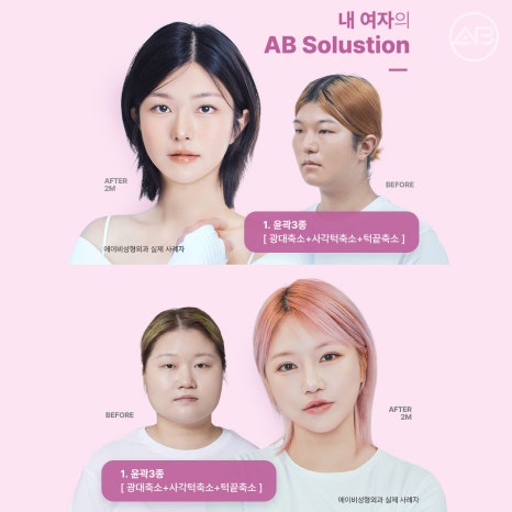 자려한안면윤곽 원한다면 AB성형외과 관련 이미지 15