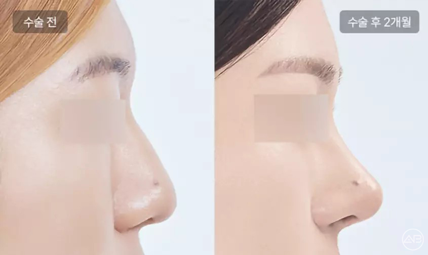 에이비성형외과 자려한 비주라인 코성형수술 관련 이미지 8