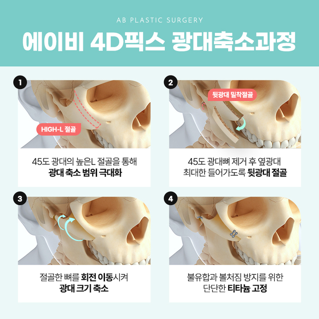 에이비성형외과 4D픽스 광대축소술 이게 뭔데? 관련 이미지 2
