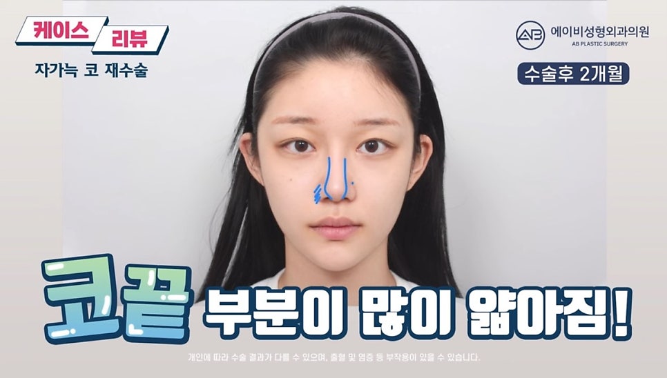 #에이비성형외과#에이비tv#케이스리뷰#코성형#코재수술 관련 이미지 4
