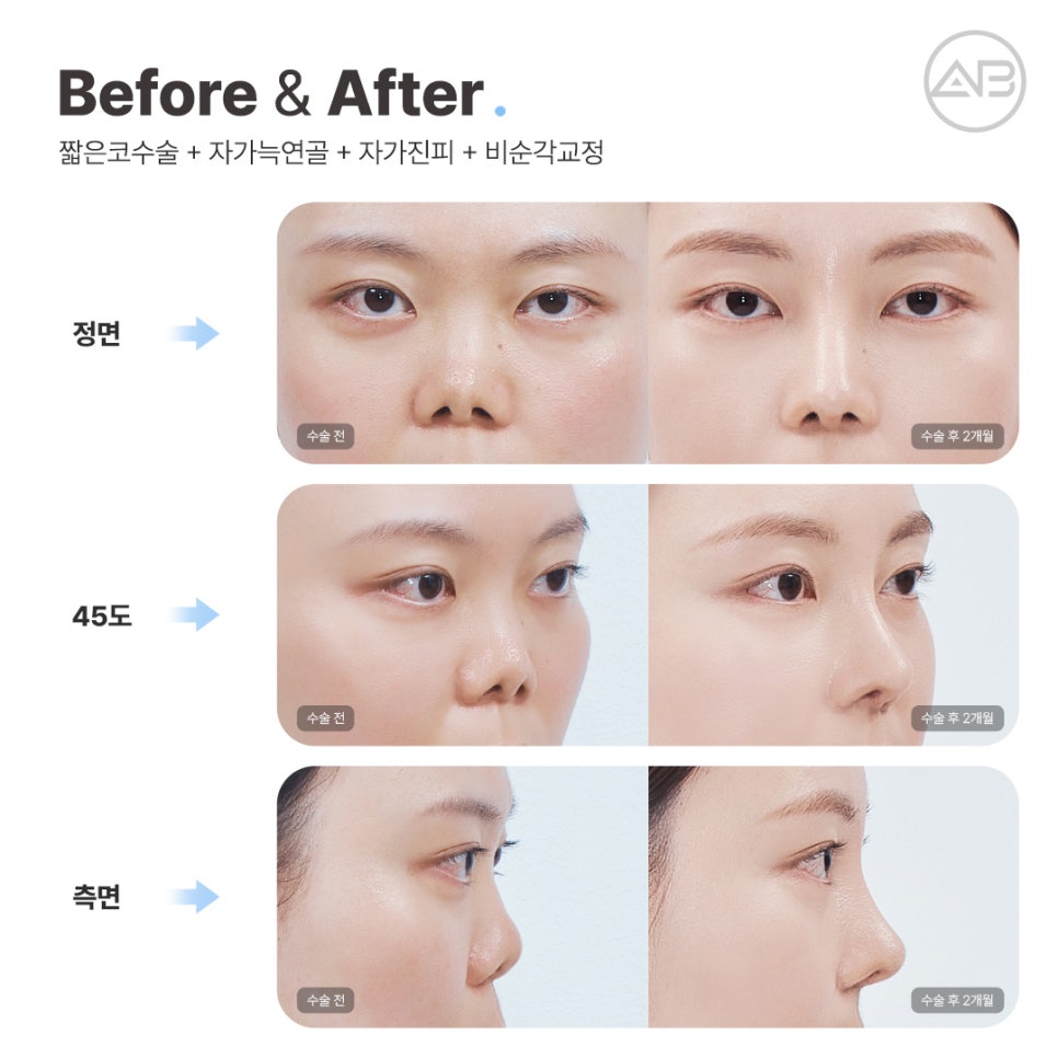 AB Plastic Surgery Contracted Nose Autologous Rib Short Nose Revision Correction Before and After image 6