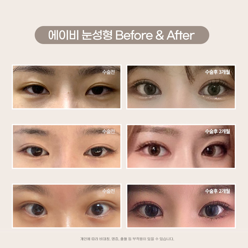 [칼럼] 안검하수가 대체 뭐죠 ? 관련 이미지 3