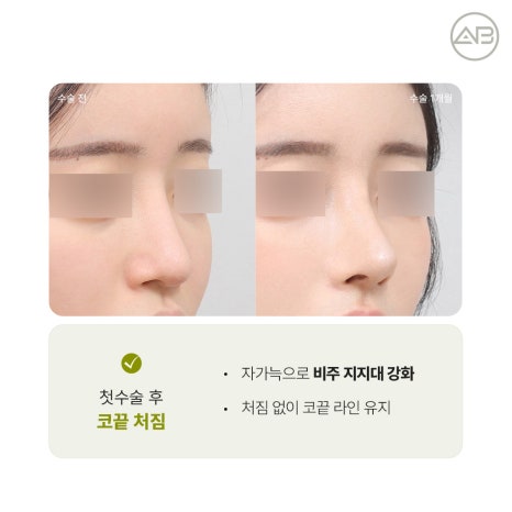 에이비성형외과 자가늑연골 비주라인 코재수술 시기와 교정 체크포인트 관련 이미지 8