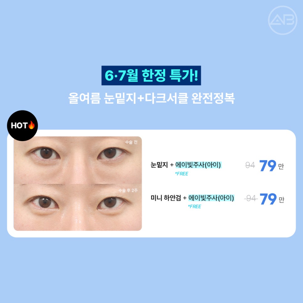 에이비성형외과 6월7월 여름 할인 이벤트 관련 이미지 2