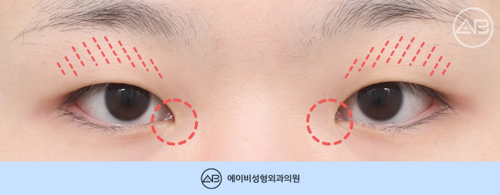 에이비성형외과 무쌍 여자 눈매교정 쌍꺼풀 수술 체크포인트 관련 이미지 2