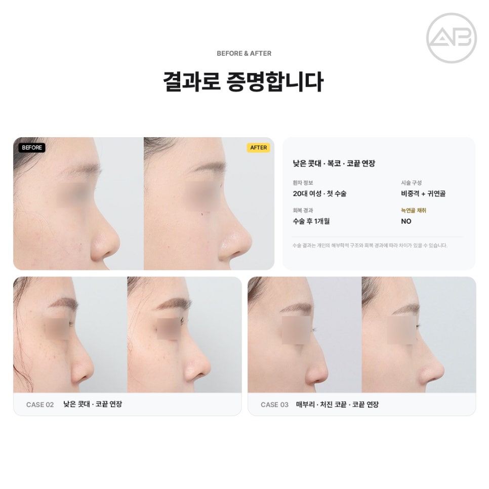 에이비성형외과 첫코 늑연골 채취 없이 비중격코성형으로 자연스럽게 관련 이미지 6