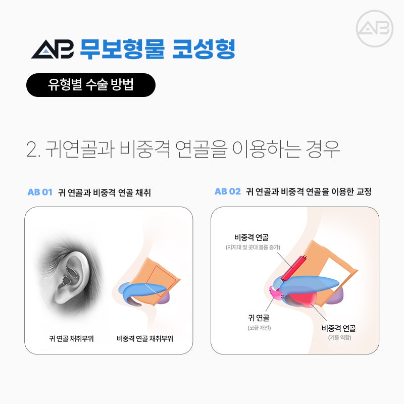 무보형물코성형 임상경험이 풍부한 에이비성형외과 관련 이미지 5