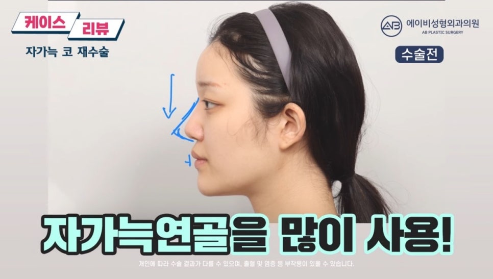 #에이비성형외과#에이비tv#케이스리뷰#코성형#코재수술 관련 이미지 3