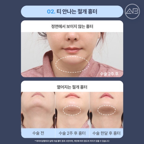 The Secret to a Slim Jawline, AB Plastic Surgery Double Chin Muscle Binding image 11
