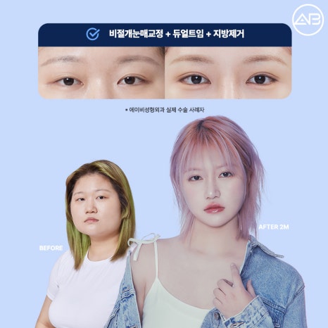처음부터 예뻤던 것처럼, 에이비성형외과 자려한투명유착 관련 이미지 9