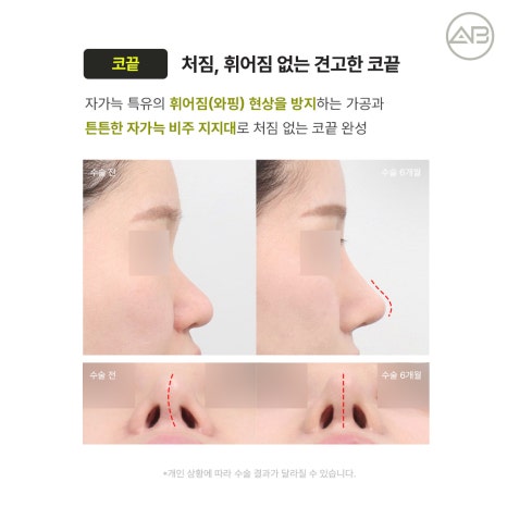 에이비성형외과 자가늑연골 비주라인 코재수술 시기와 교정 체크포인트 관련 이미지 11