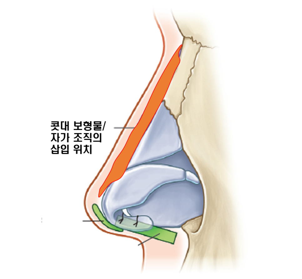Q. What Are the Advantages and Disadvantages of Autologous Tissue and Implants? image 2