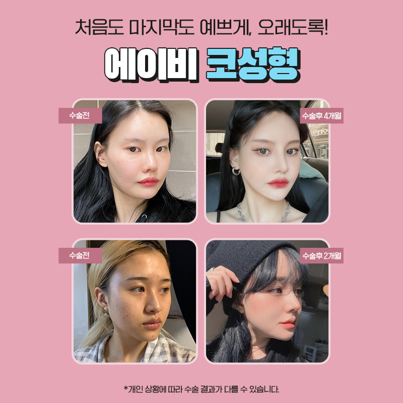 자가늑연골코성형 자신있는 코라인 관련 이미지 4
