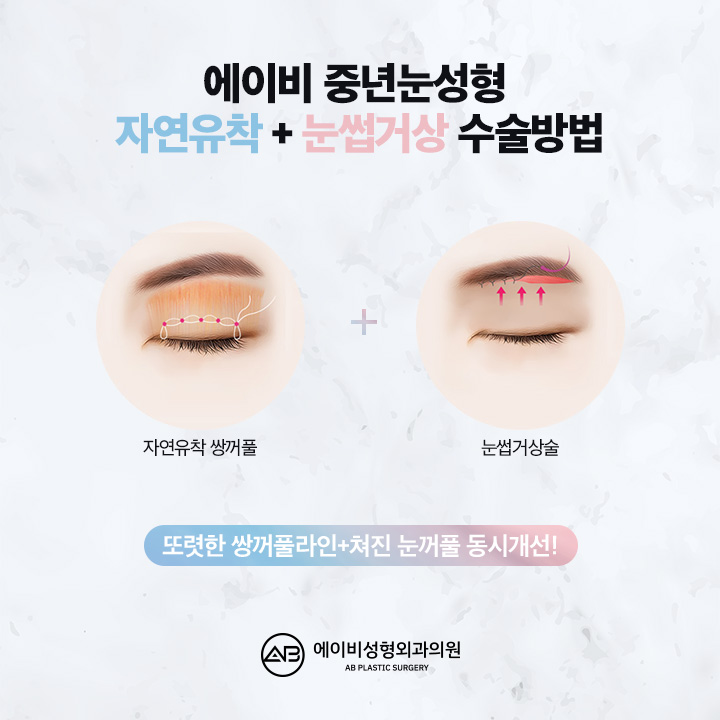 중년눈성형 에이비성형외과에서 차이를 느껴 관련 이미지 2
