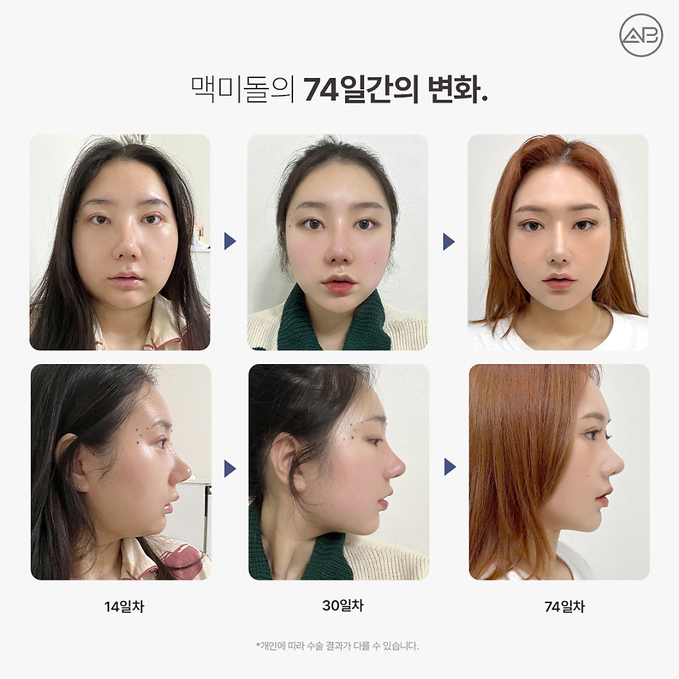 AB Plastic Surgery Make Me Girl (MAKEMEGirl) Episode 8: Makemidol Nose Surgery Review image 5
