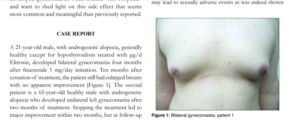 [Gynecomastia Column] Can Gynecomastia Develop After Taking Hair Loss Medication? image 4