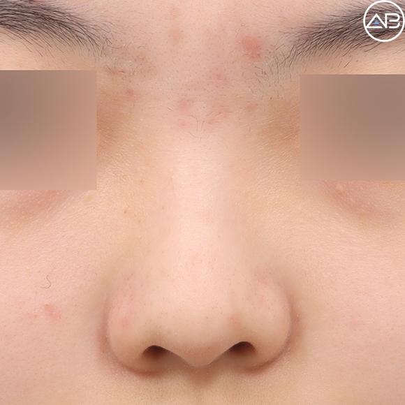 Case Review of Bulbous Nose Surgery That Transformed the Face into a Natural and Refined Look (feat. AB Plastic Surgery) image 1