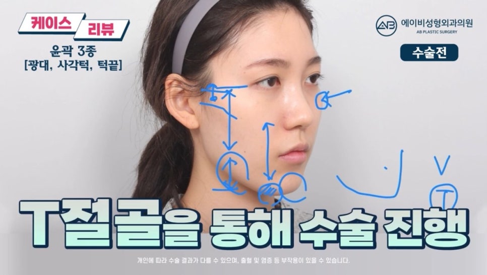 #에이비성형외과#에이비tv#케이스리뷰#안면윤곽성형 관련 이미지 3