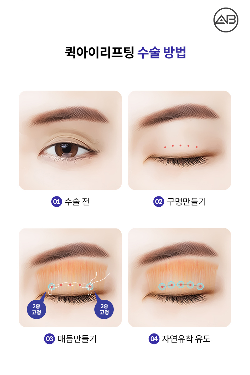 중년눈성형 퀵아이리프팅 하나면 끝 관련 이미지 4