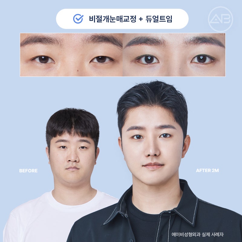 인상을 바꾸는 첫 시작, 에이비성형외과 남자눈성형 관련 이미지 19