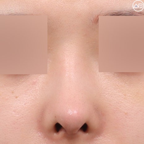 뭉툭한 복코성형, 에이비성형외과 케이스리뷰 관련 이미지 4