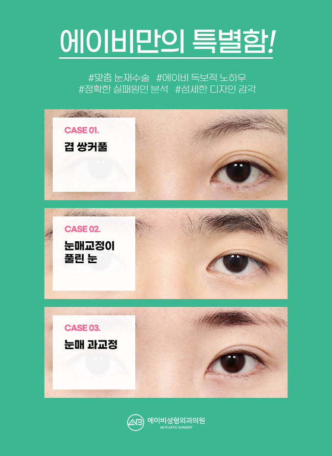 Gangnam Double Eyelid Revision Surgery Requires Caution! image 3